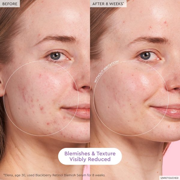 Blackberry Retinol Blemish Serum For Cheap - Image 3